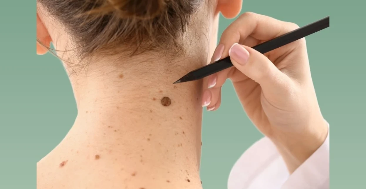 Skin Cancer Treatment