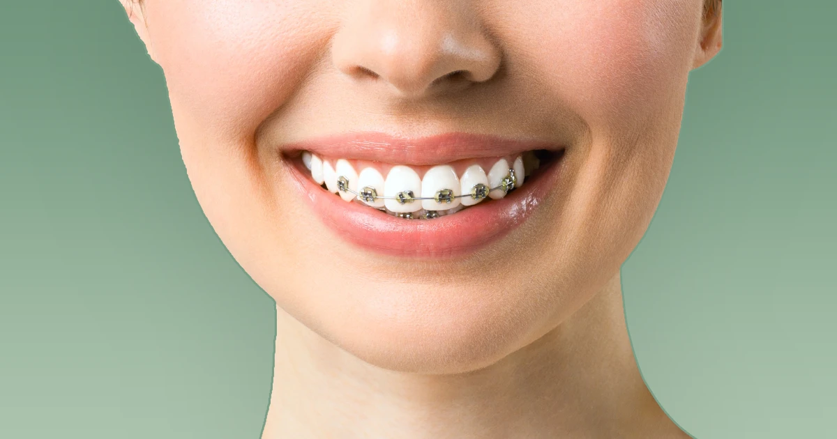 Dental Braces