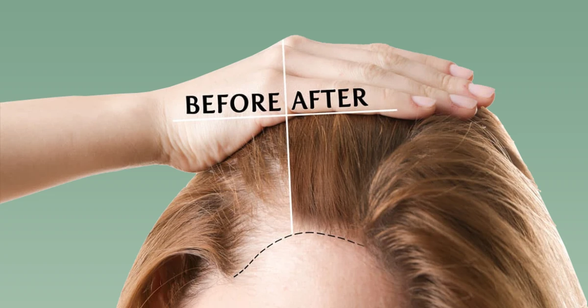 Female Hair Transplant