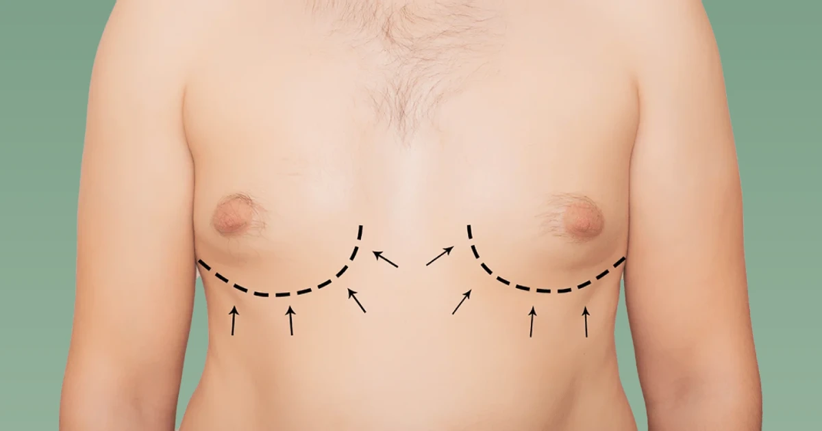 Gynecomastia Surgery